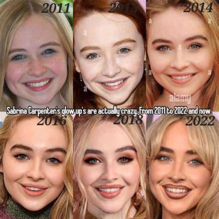 Is Sabrina Carpenter's Chin Transformation The Result Of A Chin Implant?