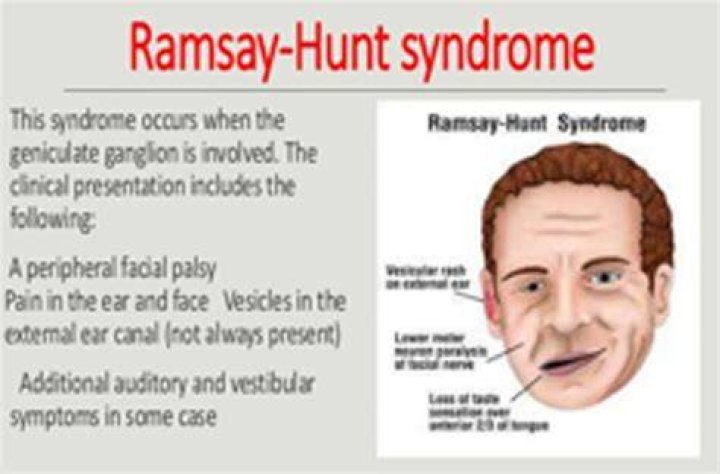 Ramsay Hunt Syndrome Causes, Symptoms, Recovery Time & Treatment