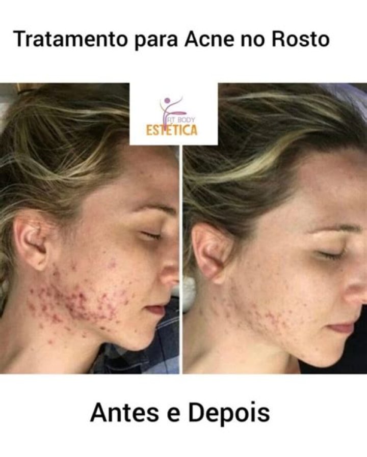 Tratamento contra acne e mutila&ccedil;&atilde;o genital A suposta castra&ccedil;&atilde;o qu&iacute;mica